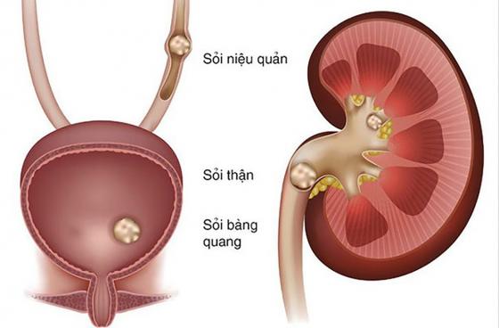 bien-chung-cua-soi-nieu-qua.jpg